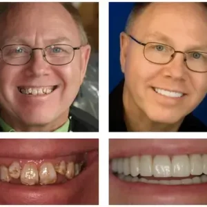 NESLEMY™ Custom-Fit Functional Dentures Smile with Confidence
