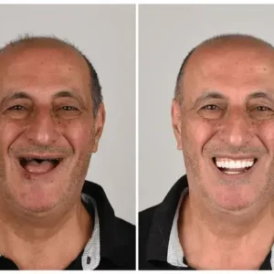 NESLEMY™ Custom-Fit Functional Dentures Smile with Confidence