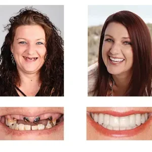 NESLEMY™ Custom-Fit Functional Dentures Smile with Confidence