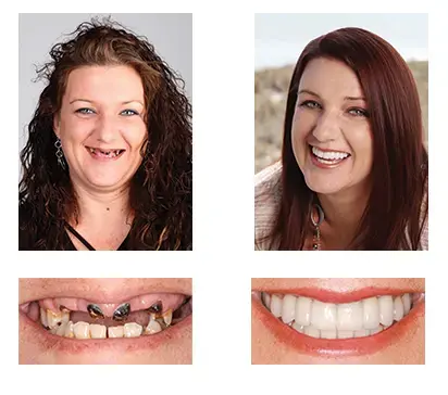 NESLEMY™ Custom-Fit Functional Dentures Smile with Confidence