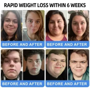 NIDDK-Tirzepatide Nano Microneedle Patch