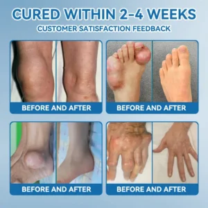 | 𝐋𝐚𝐬𝐭 𝐃𝐚𝐲 𝐏𝐫𝐨𝐦𝐨𝐭𝐢𝐨𝐧 𝟖𝟎% 𝐎𝐅𝐅 |  🇨🇦 Croaie® ʙ.ᴘ.ᴄ-157 Joint Healing Cream🦴Treats Arthritis, Neuropathy, Rheumatism, Sports Injuries & More🌸🌸