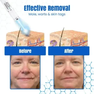 Bikenda® DermZap Mole & Wart Removal Laser Pen