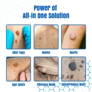 Bikenda® DermZap Mole & Wart Removal Laser Pen