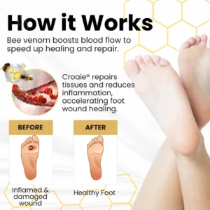 Croaie® Bee Venom Diabetic Foot Ulcer Spray ✅ 𝐕𝐢𝐬𝐢𝐛𝐥𝐞 𝐢𝐦𝐩𝐫𝐨𝐯𝐞𝐦𝐞𝐧𝐭 𝐢𝐧 𝟐-𝟑 𝐰𝐞𝐞𝐤𝐬✅