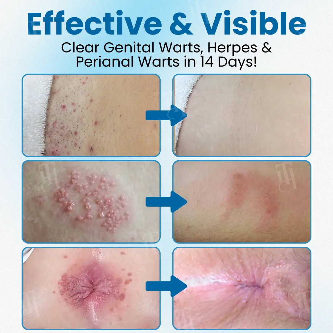 Croaieยฎ Nanolipo Genital Warts Relief Cream๐๐๐จ๐ฆ๐ฉ๐ฅ๐๐ญ๐ ๐๐๐ง๐ข๐ญ๐๐ฅ ๐๐๐ฌ๐ญ๐จ๐ซ๐๐ญ๐ข๐จ๐ง ๐ข๐ง ๐๐ ๐๐๐ฒ๐ฌ๐