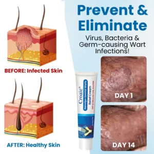 Croaieยฎ Nanolipo Genital Warts Relief Cream๐๐๐จ๐ฆ๐ฉ๐ฅ๐๐ญ๐ ๐๐๐ง๐ข๐ญ๐๐ฅ ๐๐๐ฌ๐ญ๐จ๐ซ๐๐ญ๐ข๐จ๐ง ๐ข๐ง ๐๐ ๐๐๐ฒ๐ฌ๐
