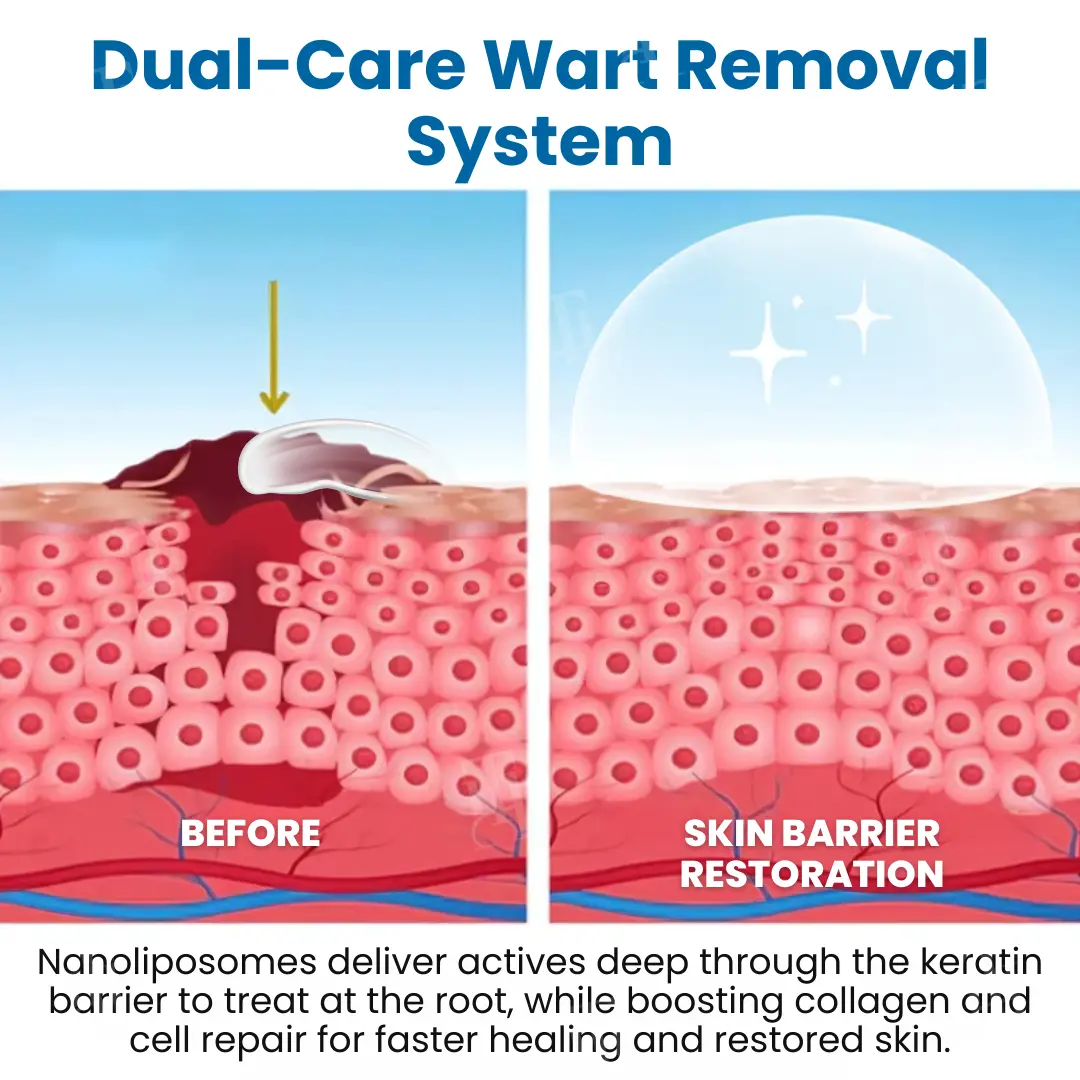 Croaieยฎ Nanolipo Genital Warts Relief Cream๐๐๐จ๐ฆ๐ฉ๐ฅ๐๐ญ๐ ๐๐๐ง๐ข๐ญ๐๐ฅ ๐๐๐ฌ๐ญ๐จ๐ซ๐๐ญ๐ข๐จ๐ง ๐ข๐ง ๐๐ ๐๐๐ฒ๐ฌ๐